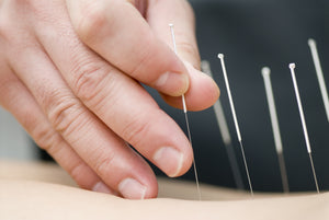 Acupuncture & Dry Needling